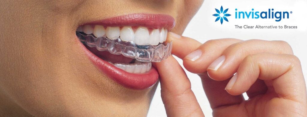 Invisalign Top