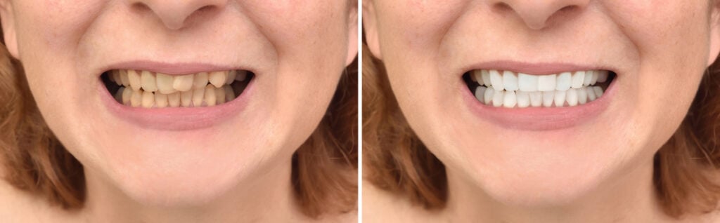 before after whitening 3