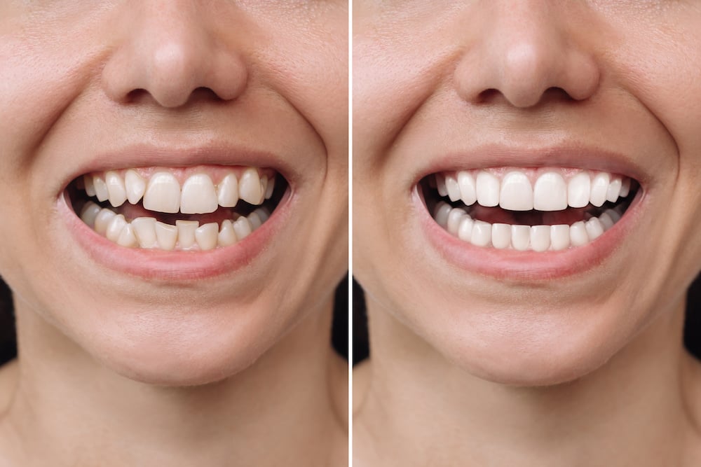 before after whitening 4