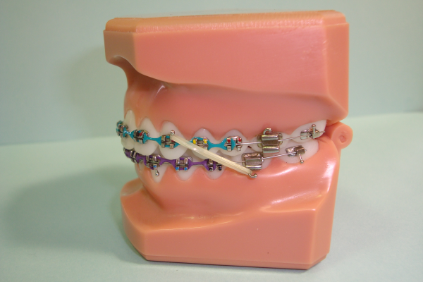 Braces Class II