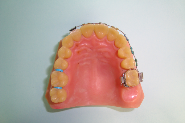Spacers