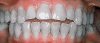 Case 3: Bite is “open” in the front and front teeth do not touch normally
