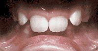 Case 8: Upper jaw has “spacing” and front teeth overlap severely