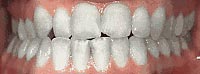 Case 5: Front teeth do not touch properly and lower jaw midline is off