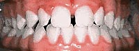 Case 6: Upper jaw has “spacing”