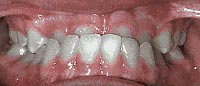 Case 4: Upper teeth are inside the lower teeth or “underbite”
