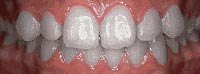 Case 7: Upper jaw has “crowding” and front teeth overlap