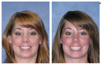 before after4